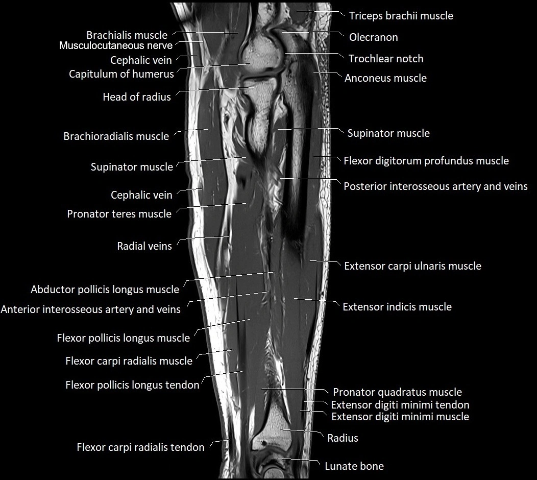MRI 3T forearm sagittal labelled cross sectional anatomy image 20.webp